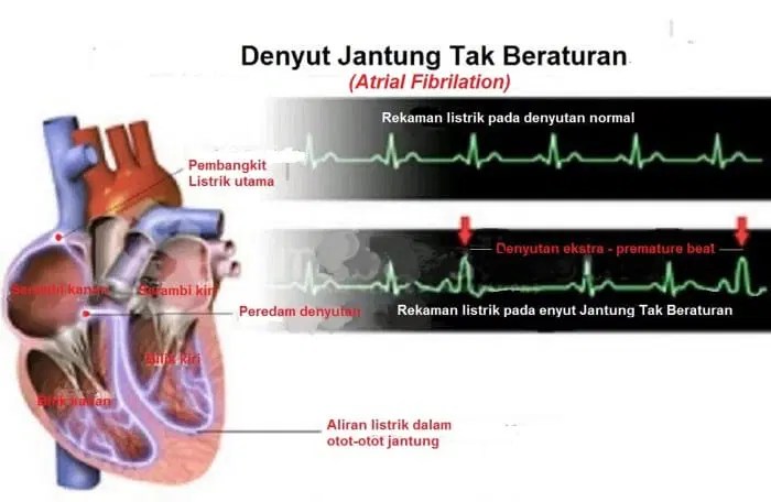 Cara Mengukur Denyut Nadi Normal Saat Latihan