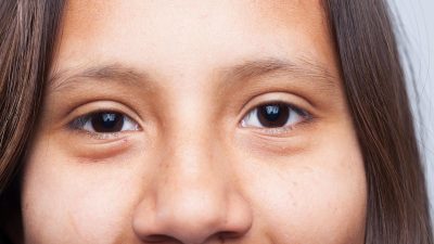 Fakta tentang Ptosis, Kondisi Medis yang Sering Disebut ‘Mata Ngantuk’