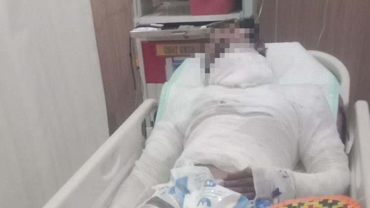 Sopir Truk Bali yang Terbakar oleh Bosnya Meninggal Dunia setelah Seminggu Kritis